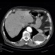 Pseudoaneurysm of aorta, replacement of ascending aorta, haemothorax: CT - Computed tomography
